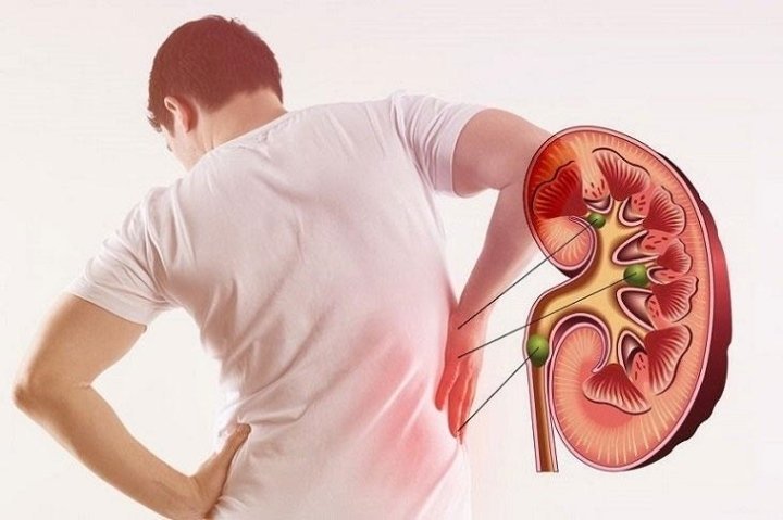Những câu hỏi thường gặp liên quan đến bệnh suy thận - Hakichi 2 thoi quen gay soi than