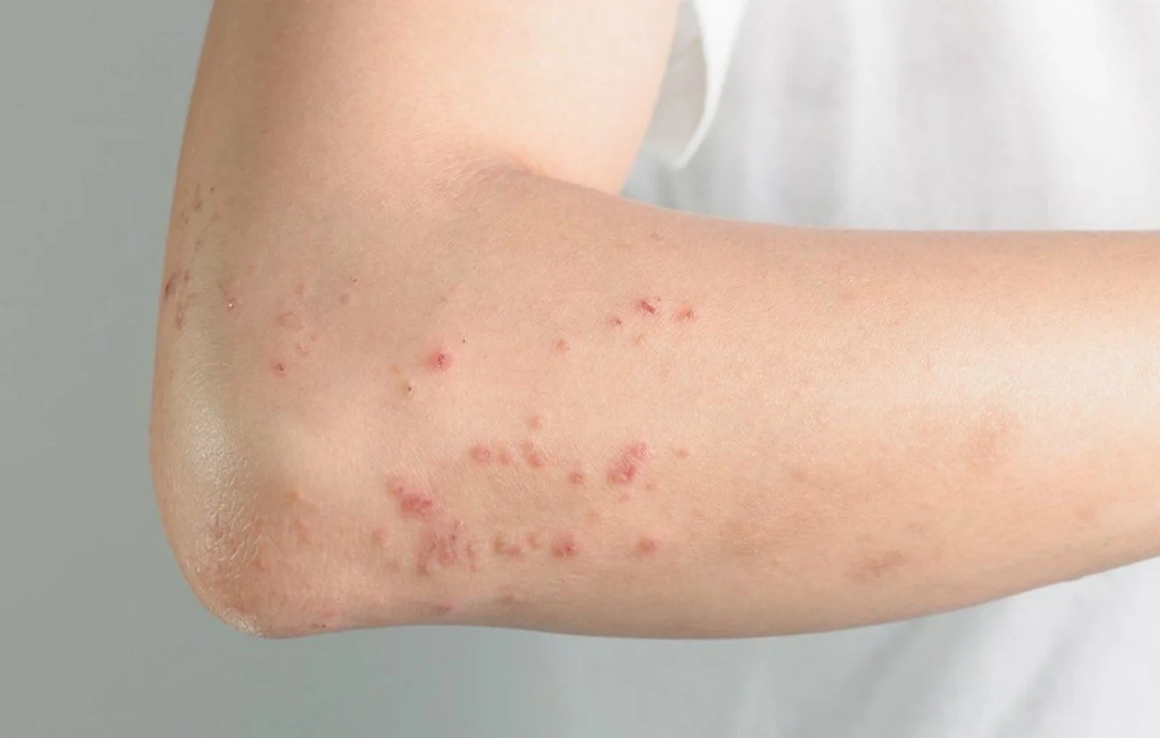 Dấu hiệu của bệnh sởi: Cách nhận diện và phòng ngừa hiệu quả - Hakichi 3 dau hieu cua benh soi