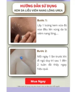 Kem da liễu viêm nang lông UREA - Kem UREA đào thải bít tắc lỗ chân lông, cấp ẩm ngăn ngừa mụn, chăm sóc da khỏe mạnh 9 kemviemda5