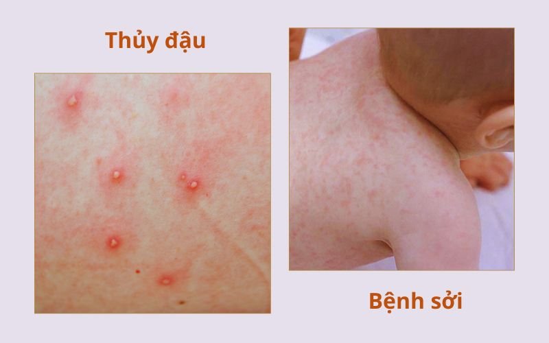 phan biet soi va thuy dau