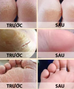 Kem chặn đứng á sừng UBIS, Kem Dưỡng Phục Hồi Da Viêm, Nấm Ngứa Cơ Địa Lâu Năm Hủ 40gram 7 ubis9