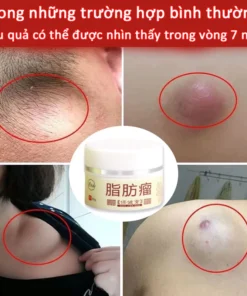 Kem loại bỏ u mỡ tan u mỡ Kem lipoma Loại bỏ mỡ dưới da 30g Tinh chất thảo mộc tự nhiên Giảm đau thần kinh gân khớp 14 tanmo4