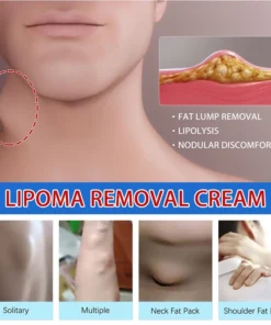 Kem loại bỏ u mỡ tan u mỡ Kem lipoma Loại bỏ mỡ dưới da 30g Tinh chất thảo mộc tự nhiên Giảm đau thần kinh gân khớp 15 tanmo5