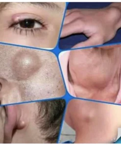 Kem loại bỏ u mỡ tan u mỡ Kem lipoma Loại bỏ mỡ dưới da 30g Tinh chất thảo mộc tự nhiên Giảm đau thần kinh gân khớp 16 tanmo6