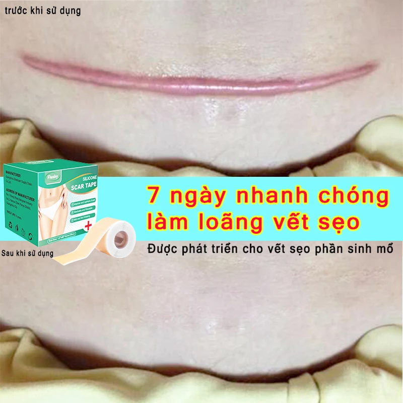 miếng dán sẹo Làm Mờ Sẹo Sau Phẫu Thuật Xóa Sạch Sẹo Thâm loại bỏ hiệu quả các vết sẹo lâu năm,vết thương,phỏng bô 2 miếng dán sẹo Làm Mờ Sẹo Sau Phẫu Thuật Xóa Sạch Sẹo Thâm loại bỏ hiệu quả các vết sẹo lâu năm,vết thương,phỏng bô - Ảnh 2