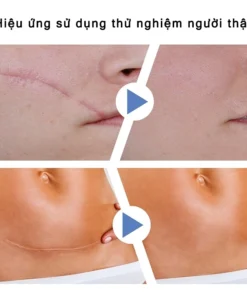 miếng dán sẹo Làm Mờ Sẹo Sau Phẫu Thuật Xóa Sạch Sẹo Thâm loại bỏ hiệu quả các vết sẹo lâu năm,vết thương,phỏng bô 14 danseo4