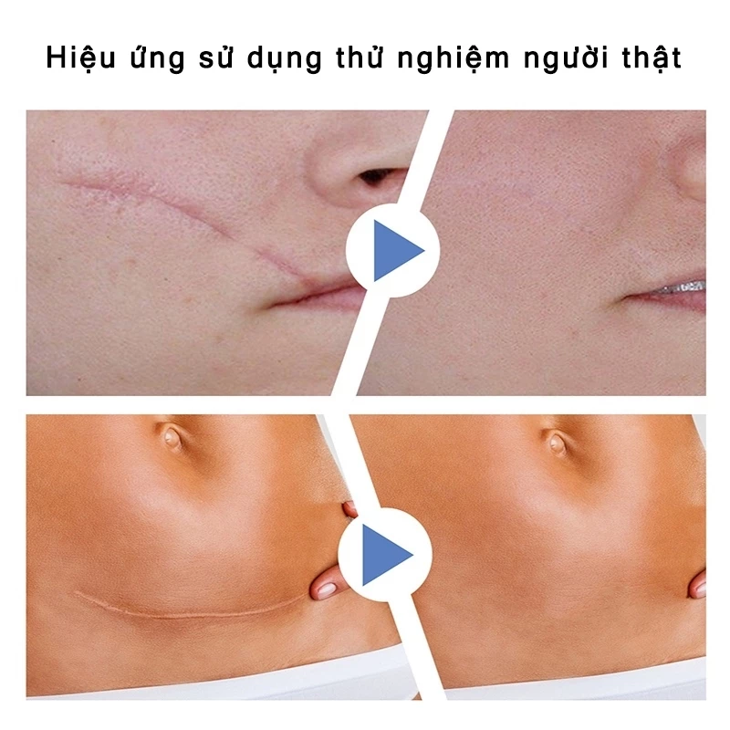 miếng dán sẹo Làm Mờ Sẹo Sau Phẫu Thuật Xóa Sạch Sẹo Thâm loại bỏ hiệu quả các vết sẹo lâu năm,vết thương,phỏng bô 5 miếng dán sẹo Làm Mờ Sẹo Sau Phẫu Thuật Xóa Sạch Sẹo Thâm loại bỏ hiệu quả các vết sẹo lâu năm,vết thương,phỏng bô - Ảnh 5