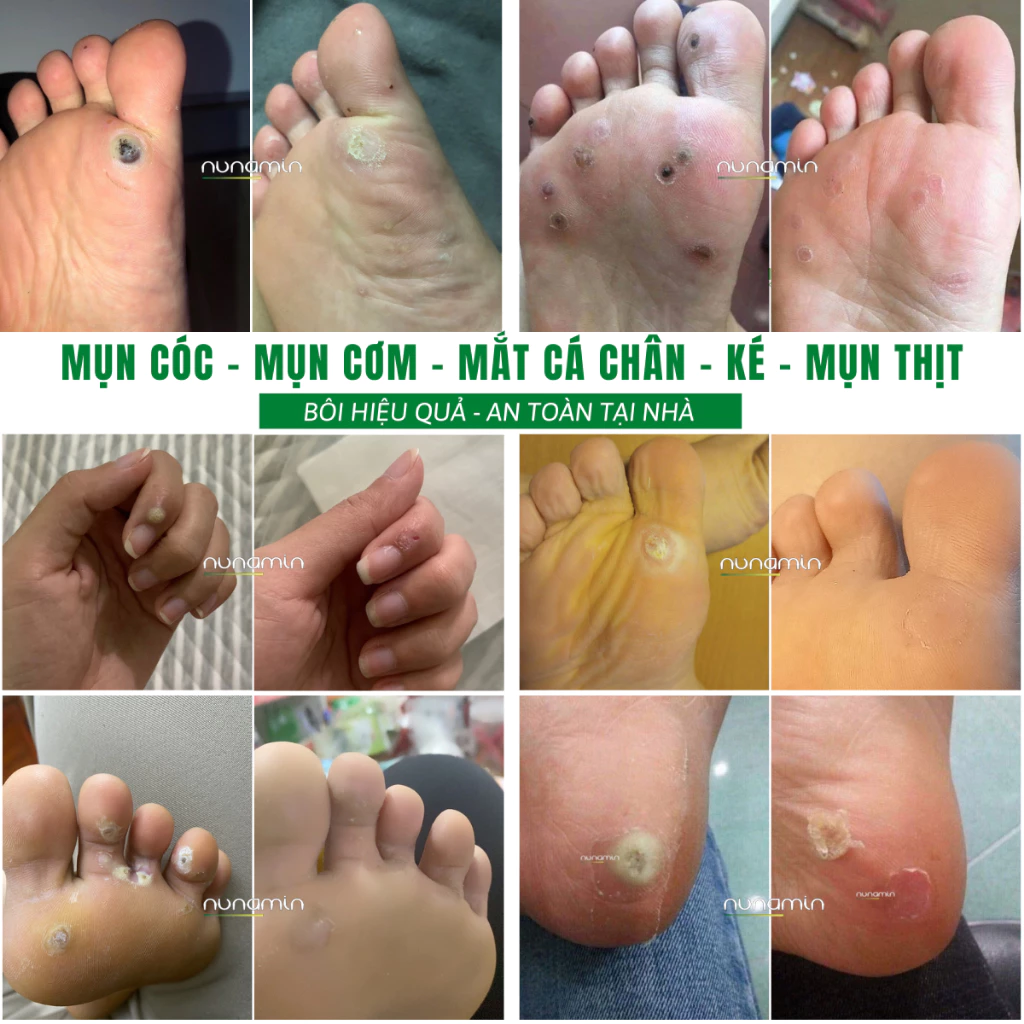 Tinh Chất Thảo Mộc NUNAMIN 15ML - Hỗ Trợ Xử Lý Mụn Cóc, Mụn Thịt, Mắt Cá Chân Tay 10 Tinh Chất Thảo Mộc NUNAMIN 15ML - Hỗ Trợ Xử Lý Mụn Cóc, Mụn Thịt, Mắt Cá Chân Tay - Ảnh 10
