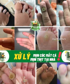 Tinh Chất Thảo Mộc NUNAMIN 15ML - Hỗ Trợ Xử Lý Mụn Cóc, Mụn Thịt, Mắt Cá Chân Tay 15 serumtaymun4
