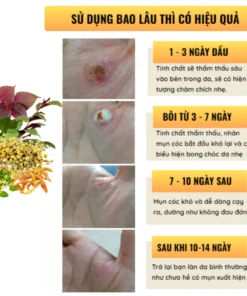 Tinh Chất Thảo Mộc NUNAMIN 15ML - Hỗ Trợ Xử Lý Mụn Cóc, Mụn Thịt, Mắt Cá Chân Tay 12 seurmtaymun3