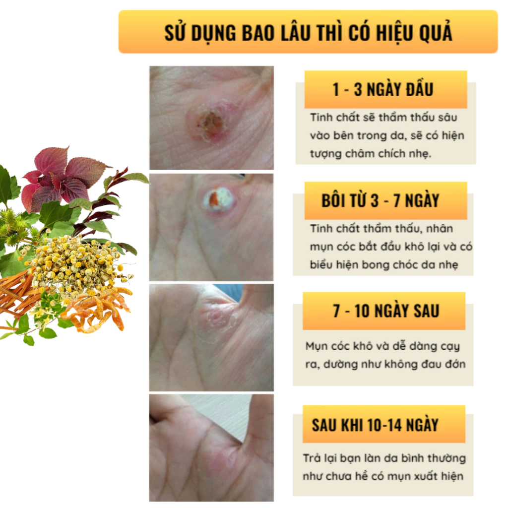Tinh Chất Thảo Mộc NUNAMIN 15ML - Hỗ Trợ Xử Lý Mụn Cóc, Mụn Thịt, Mắt Cá Chân Tay 2 Tinh Chất Thảo Mộc NUNAMIN 15ML - Hỗ Trợ Xử Lý Mụn Cóc, Mụn Thịt, Mắt Cá Chân Tay - Ảnh 2