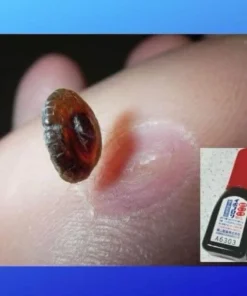 Tinh chất bôi mụn cóc Ibokorori Nhật Bản, giúp bạn thoát khỏi sự phiền toái, khó chịu mà mụn cóc mang lại - Ảnh 3