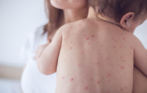 Phân biệt sởi và thủy đậu chi tiết - Hakichi