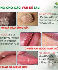 [MỤN VÙNG KÍN] Tinh Chất Hỗ Trợ Xử Lý Sùi Mào Gà, Hạt Ngọc, Mụn Li Ti 10ml (Che Tên) 10ML - Ảnh 4