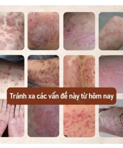 Kem Nhật Bản Bôi Nấm Kem Bôi Hắc Lào Thảo Dược, Phát Ban Tổ Đĩa - Ảnh 9