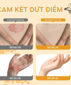 Kem Bôi Viêm Da Cơ Địa Xuất NHẬT BẢN - Hỗ Trợ Hắc Lào, Tổ Đỉa, Á Sừng, Nước Ăn Chân Tay - Ảnh 5