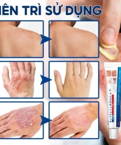 Kem Bôi Viêm Da Cơ Địa Xuất NHẬT BẢN - Hỗ Trợ Hắc Lào, Tổ Đỉa, Á Sừng, Nước Ăn Chân Tay - Ảnh 6