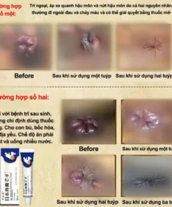 Kem Bôi Trĩ Nhật Bản SHORIN-Kem SHORIN Cải Thiện Tình Trạng Trĩ Ngoại Trĩ Nội Ngoại - Ảnh 4