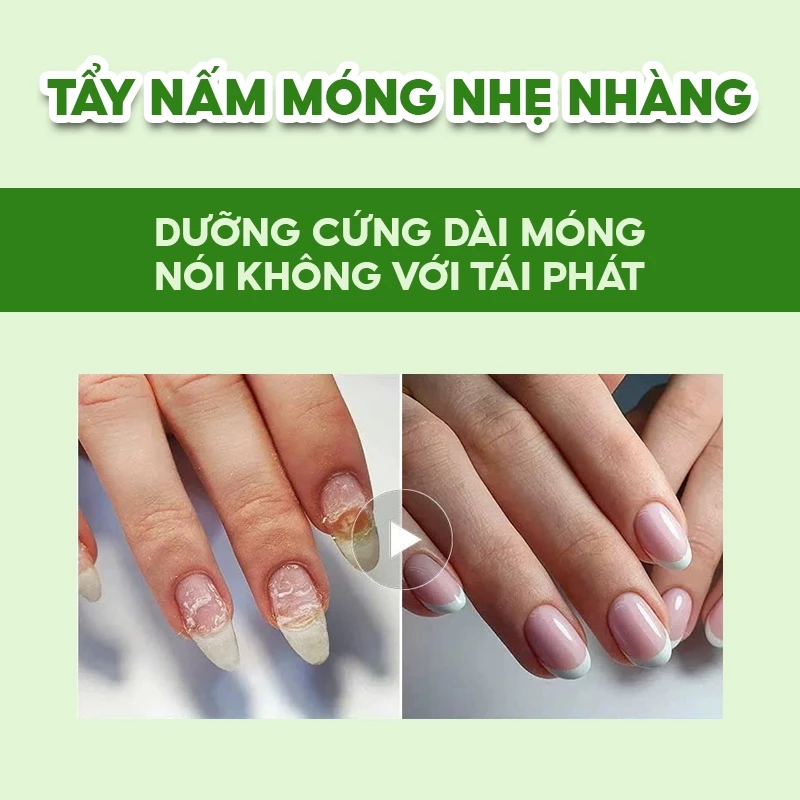Bôi Nấm Móng Tay Chân CHA-REN Hàng Xuất Khẩu Châu Âu (EU) Phục Hồi Móng Mới Hết Hư Khoé, Bọng Móng 28 mognchan3