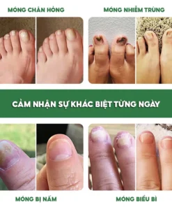 Bôi Nấm Móng Tay Chân CHA-REN Hàng Xuất Khẩu Châu Âu (EU) Phục Hồi Móng Mới Hết Hư Khoé, Bọng Móng 13 Bôi Nấm Móng Tay Chân CHA-REN Hàng Xuất Khẩu Châu Âu (EU) Phục Hồi Móng Mới Hết Hư Khoé, Bọng Móng - Ảnh 4