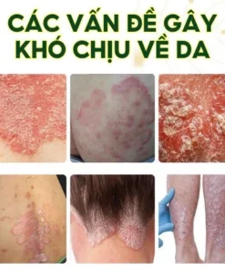 Kem bôi nấm ngứa ngoài da nội địa trung(nấm nhật bản) - Ảnh 7