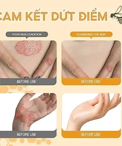 Kem bôi nấm ngứa ngoài da nội địa trung(nấm nhật bản) - Ảnh 8