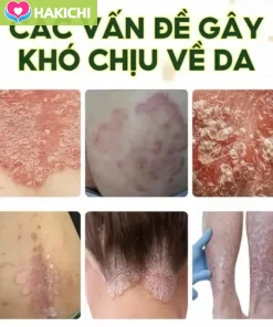 Combo 3 Tuýp Kem Bôi Da Liễu Nhật Bản 15gam Bôi Nấm Ngứa Hắc Lào Vẩy Nến Á Sừng Tổ Đỉa Ghẻ Nước - Ảnh 7
