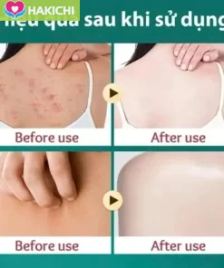 Combo 3 Tuýp Kem Bôi Da Liễu Nhật Bản 15gam Bôi Nấm Ngứa Hắc Lào Vẩy Nến Á Sừng Tổ Đỉa Ghẻ Nước - Ảnh 9